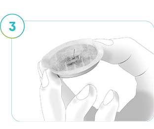 Bilde som viser SmartGuide CGM fjernet fra huden.